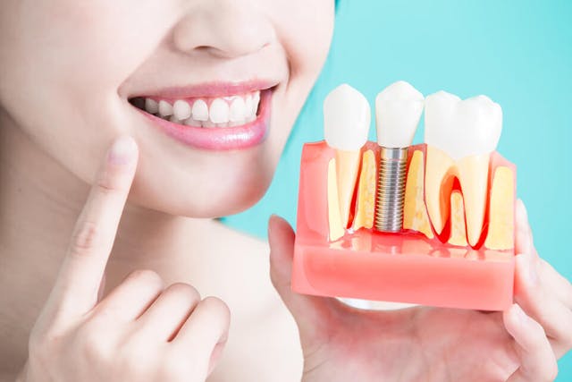 Caring for Your Implants/Dentures