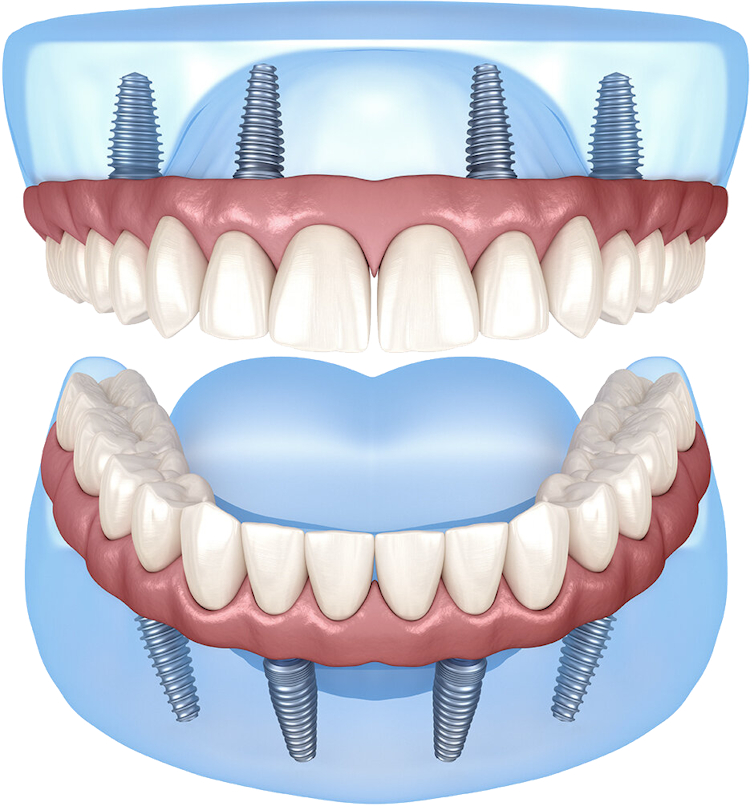 Dental Implants and All-In-4 Implants