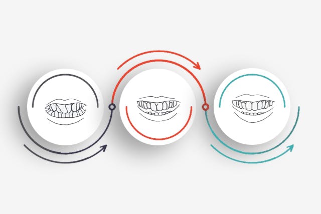 How does Invisalign work