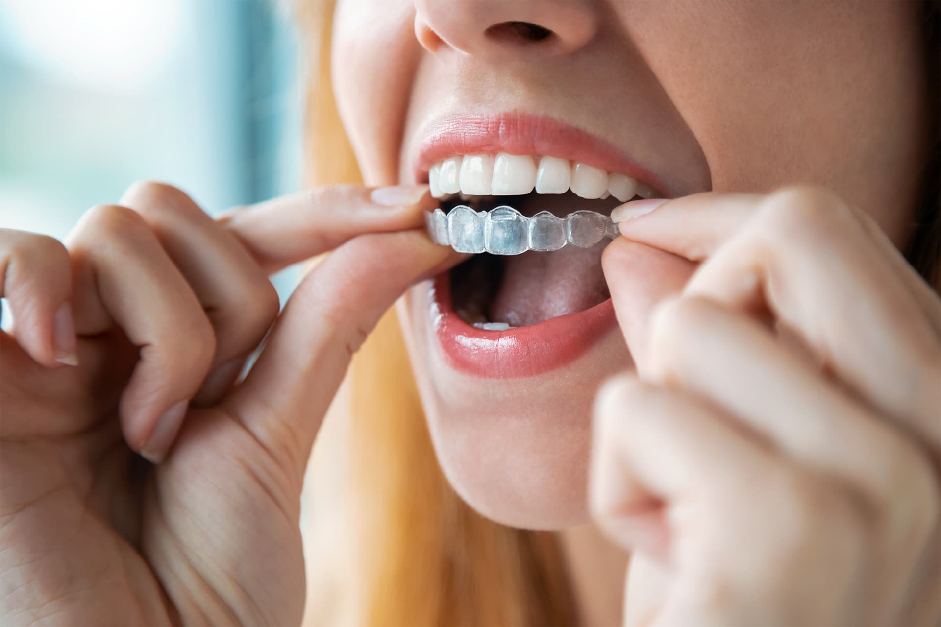 Invisalign - Family Dentistry on Manchaca