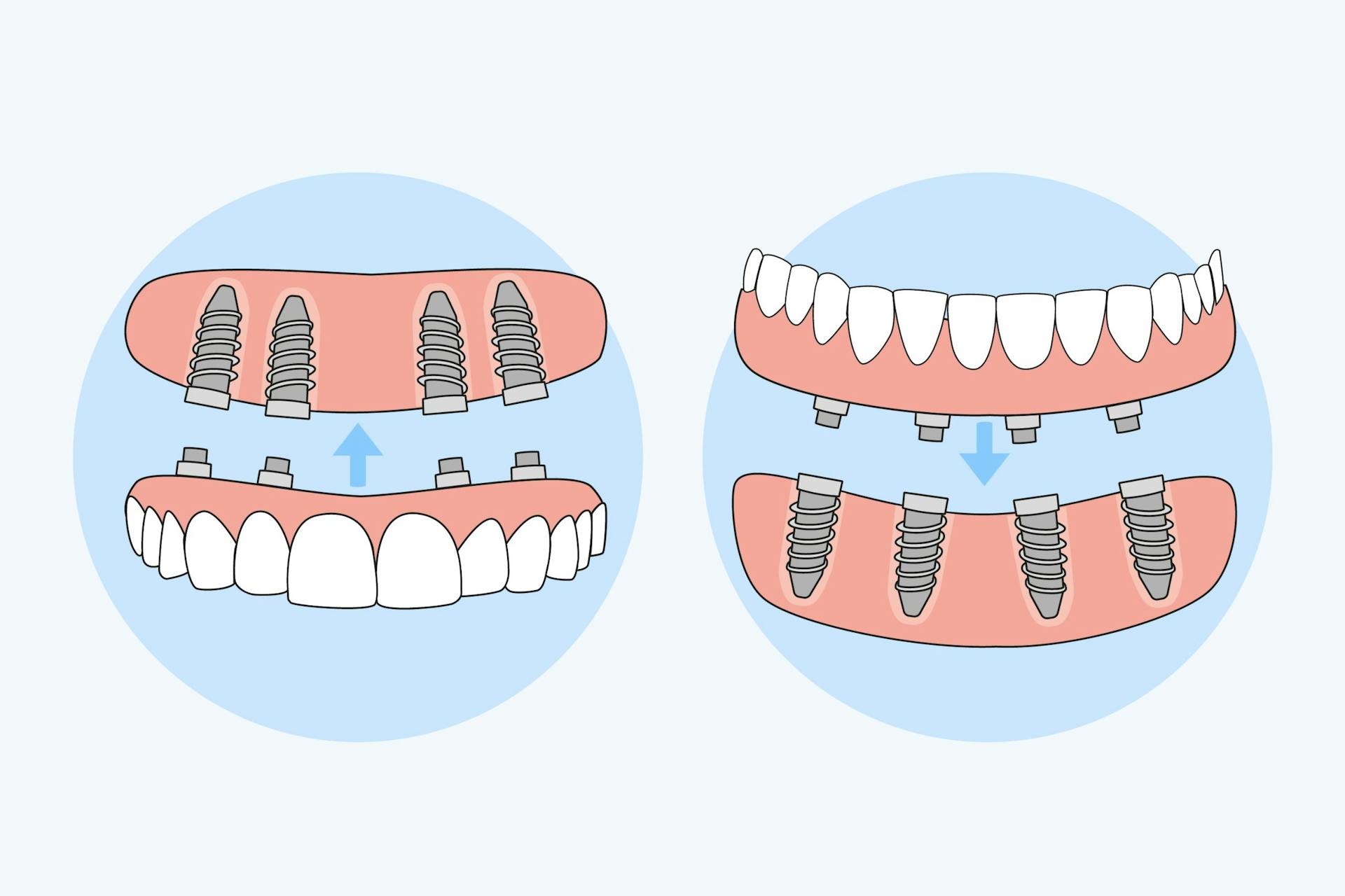 What Are Dental Implants and All-on-4? - Family Dentistry on Manchaca