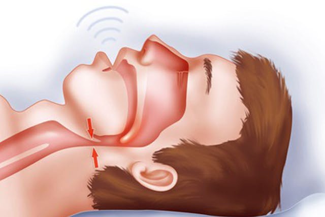 Alternativas a CPAP para Apnea del Sueño